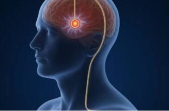 DBS for Advanced Parkinsons' Disease: Brain Pacemaker Surgery by Expert DBS Surgeon