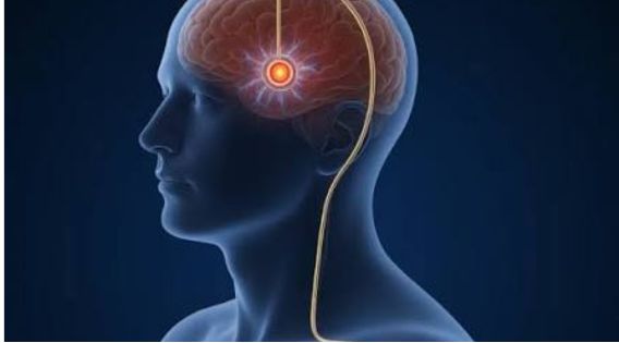 DBS for Advanced Parkinsons' Disease: Brain Pacemaker Surgery by Expert DBS Surgeon