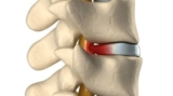 Consult a Top Neuro Spine Surgeon in Kolkata for Disc Replacement Surgery in India