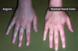 Skin discolouration: Why is it really bluish?